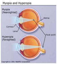 Myopia-and-Hyperopia-in-the-Eye